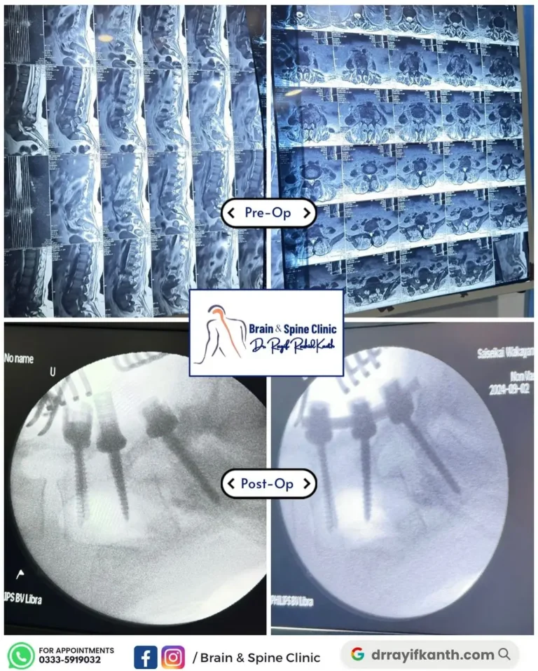 Image of a successful Retrolisthesis spine surgery case performed by Dr. Rayif Kanth at the Brain and Spine Clinic, Islamabad.