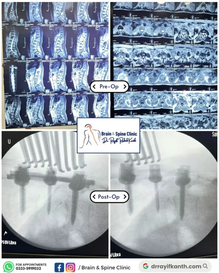 Image showing a successful T11-12 spine fusion surgery performed by Dr. Rayif Kanth at the Brain and Spine Clinic, helping a 71-year-old patient regain mobility.