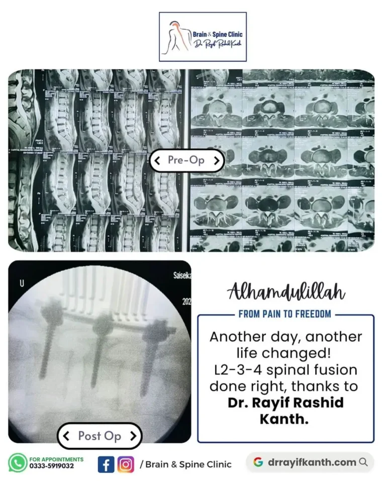 Image showcasing a successful L2-3-4 spinal fusion surgery performed by Dr. Rayif Rashid Kanth at the Brain and Spine Clinic, Islamabad.