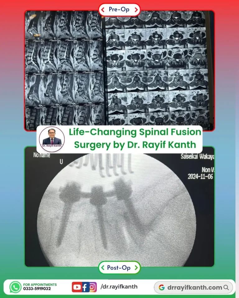 A 52-year-old female patient suffering from severe claudication found new hope at the hands of Pakistan’s leading spine surgeon, Dr. Rayif Kanth. After a complex L4-5-S1 spinal fusion surgery, the patient is now pain-free and fully mobile. Alhamdulillah!