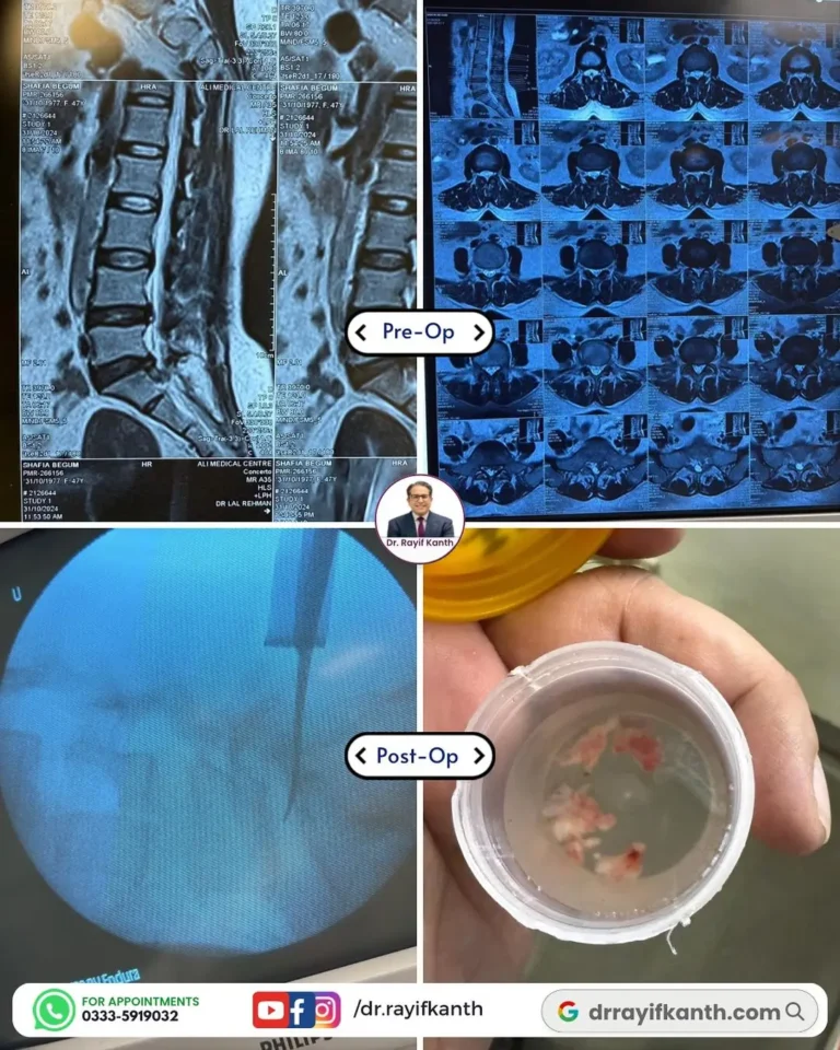 Rapid Recovery After L5-S1 Microdiscectomy Migrated disc successfully treated by Dr. Rayif Kanth, with patient mobilized in just 6 hours and pain-free.